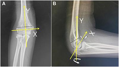 Rotation of both X- and Y-axes is a predictive confounder of ulnar nerve injury and open reduction in pediatric lateral flexion supracondylar humeral fractures: A retrospective cohort study